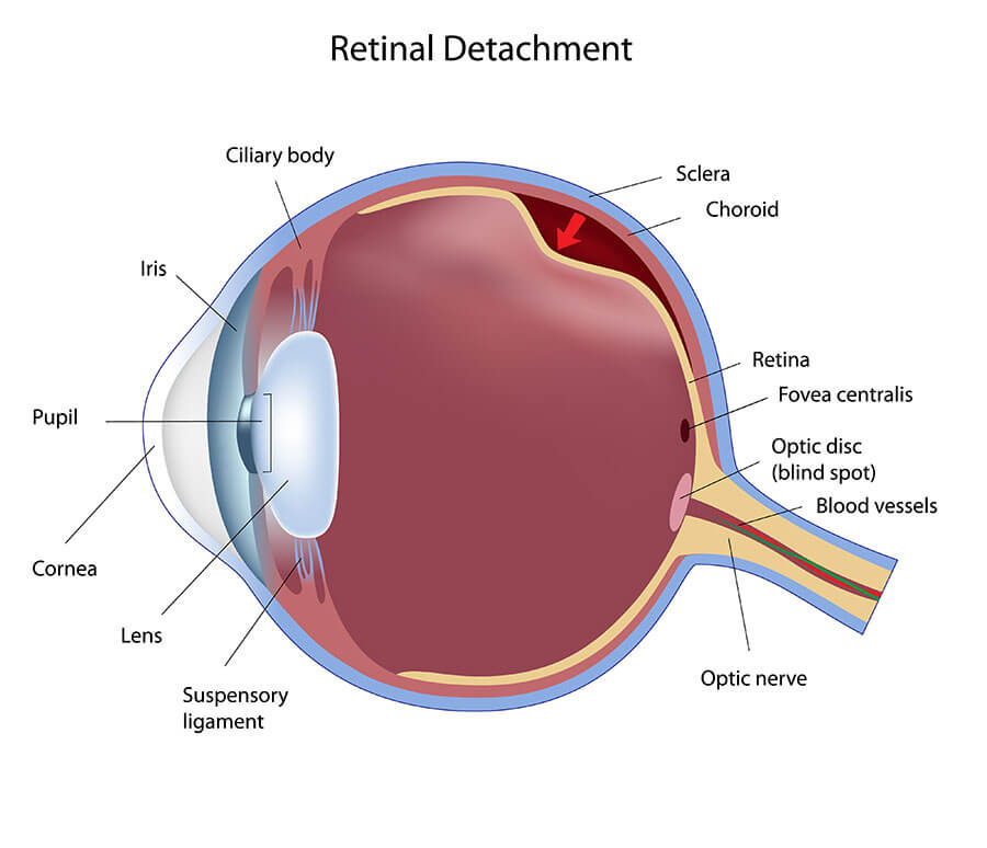 Retinal Tears Livingston Retinal Detachment Morristown Retina
